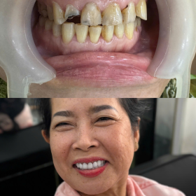 Răng sứ Titan 1,200,000