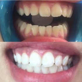 lấy cao răng Gò Vấp