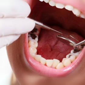 Điều trị tủy răng khôn 800,000