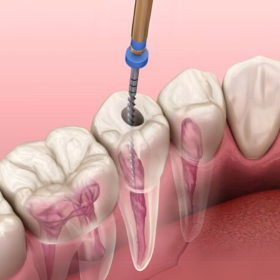 Điều trị tủy răng cối lớn 700,000
