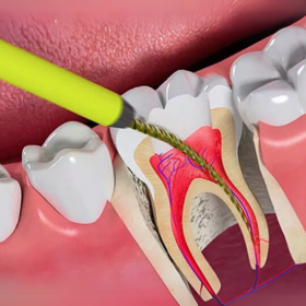 Điều trị tủy răng cối nhỏ 500,000