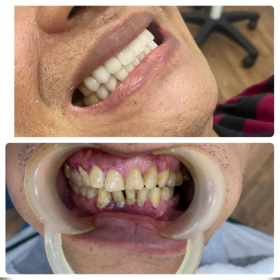 Răng sứ kim loại Mỹ 700,000