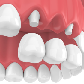 Trồng Răng Sứ Gò Vấp