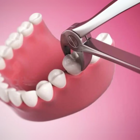 Mới nhổ răng kiêng ăn gì và nên ăn gì để nhanh hồi phục?