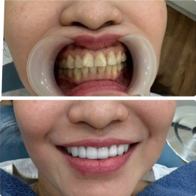 Răng sứ Zirconia Đức 2,400,000