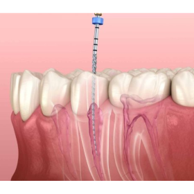 Điều trị tủy 400,000 - 500,000