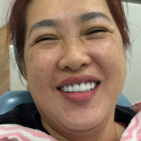 Răng sứ DD Bio 2,800,000
