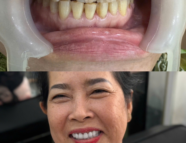 Răng sứ Titan 1,200,000