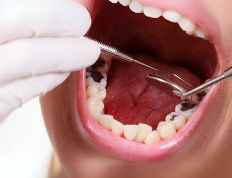 Điều trị tủy răng khôn 800,000