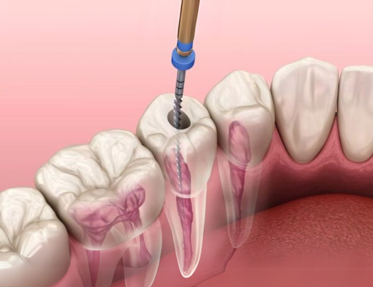 Điều trị tủy răng cối lớn 700,000