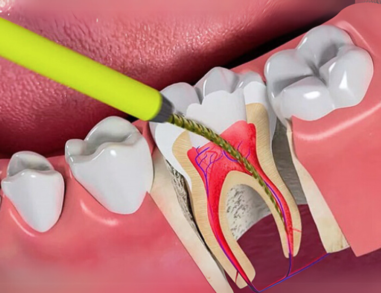 Điều trị tủy răng cối nhỏ 500,000
