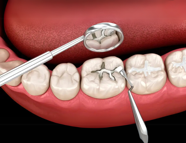 Trám răng cửa, cổ răng 150,000