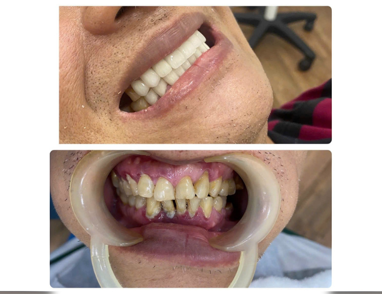 Răng sứ kim loại Mỹ 700,000