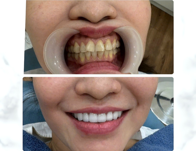 Răng sứ Zirconia Đức 2,400,000