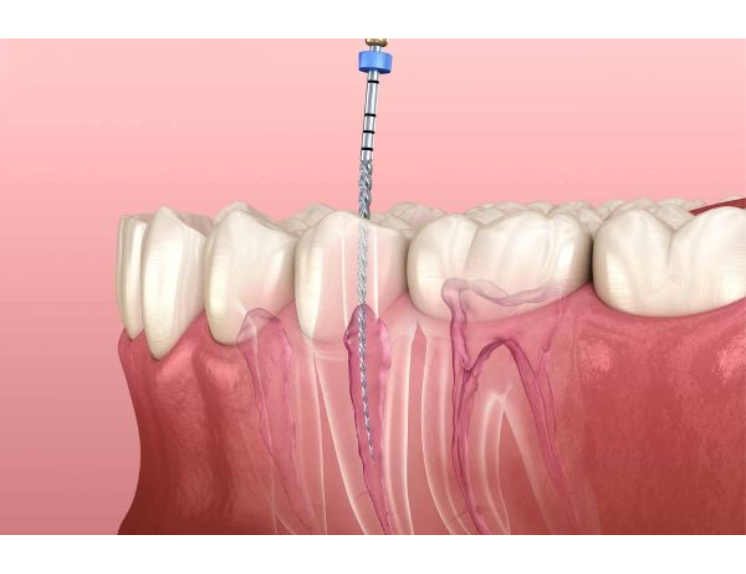 Điều trị tủy 400,000 - 500,000