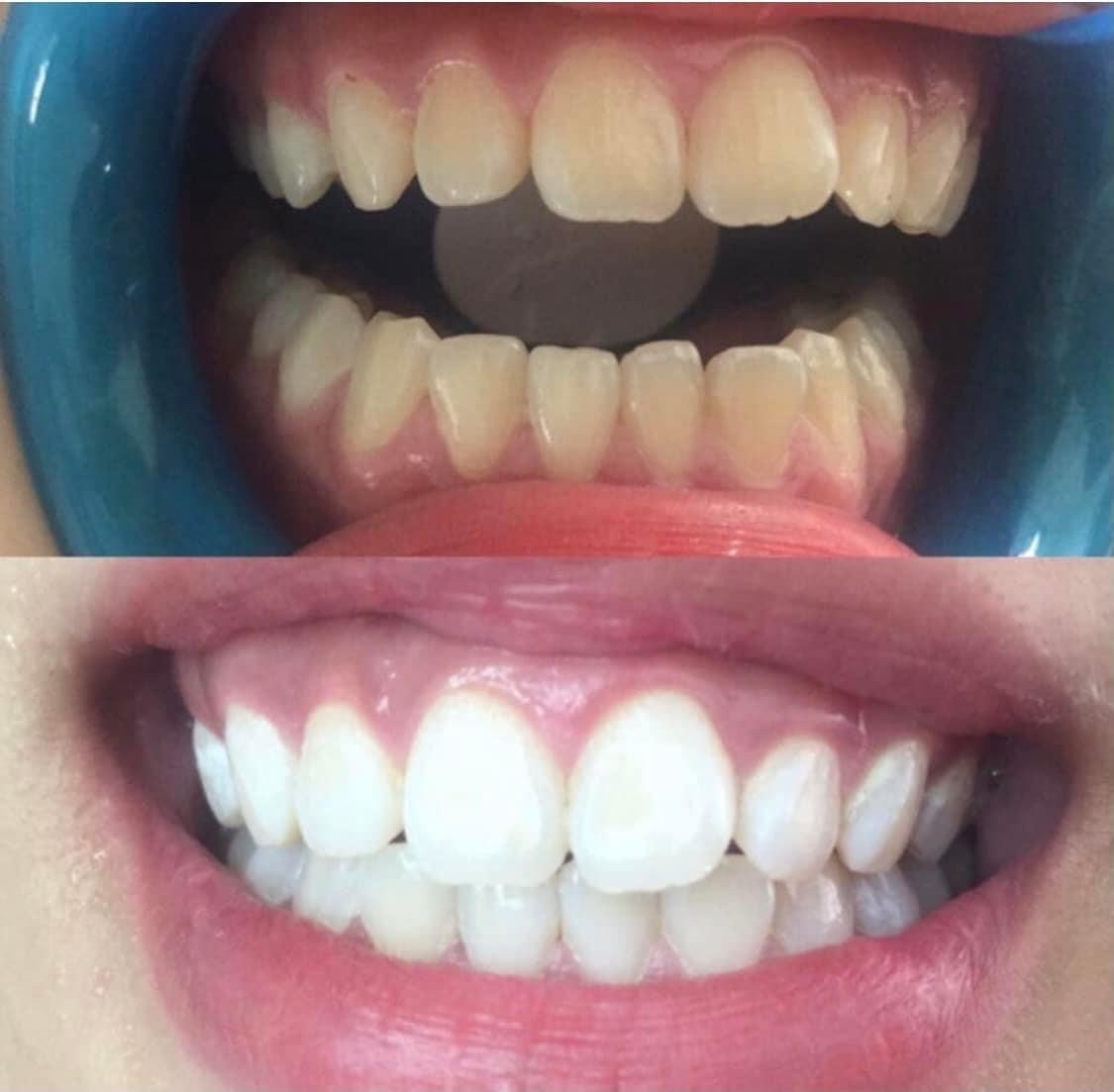 lấy cao răng Gò Vấp